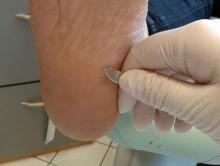 Warzenbehandlung