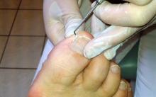 Nagelprothetik
