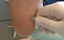 Warzenbehandlung